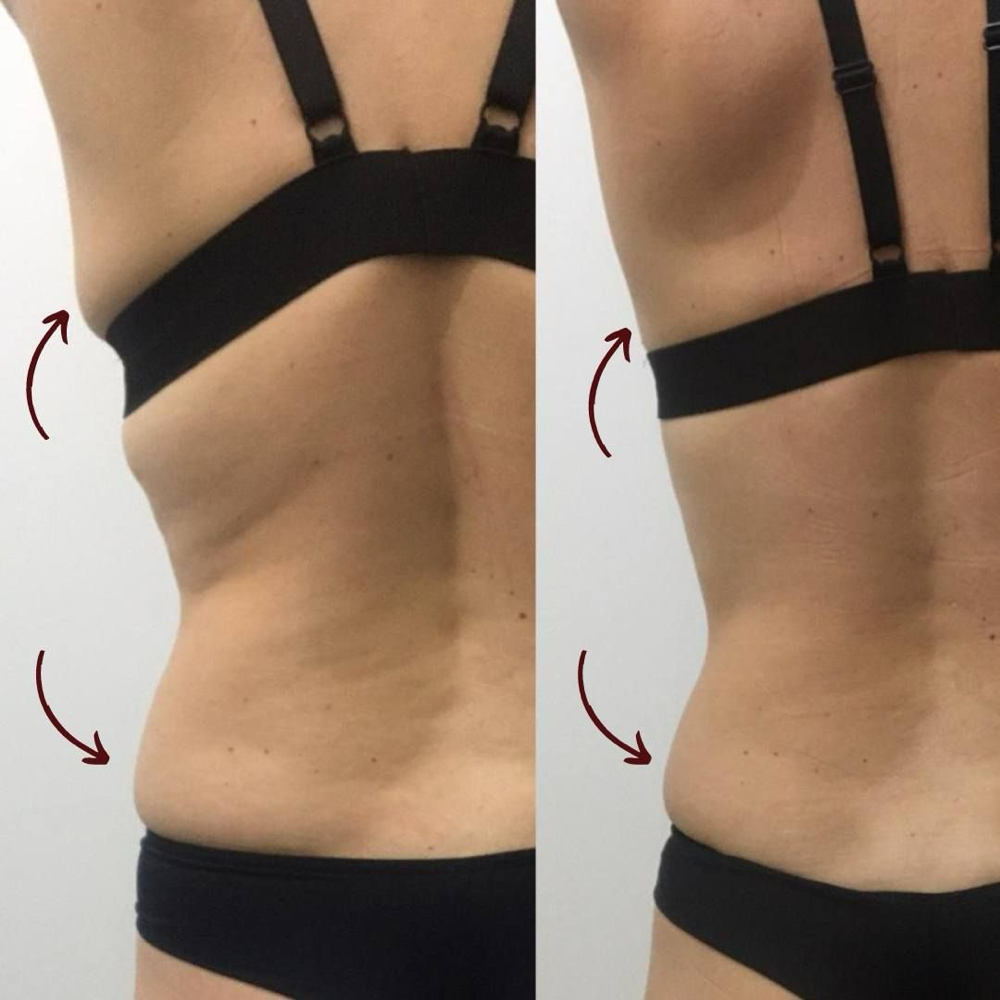 10 Session LipoDetox