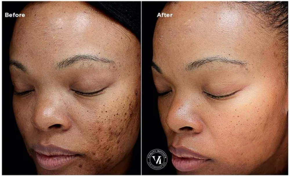 Porefection Chemical Peel