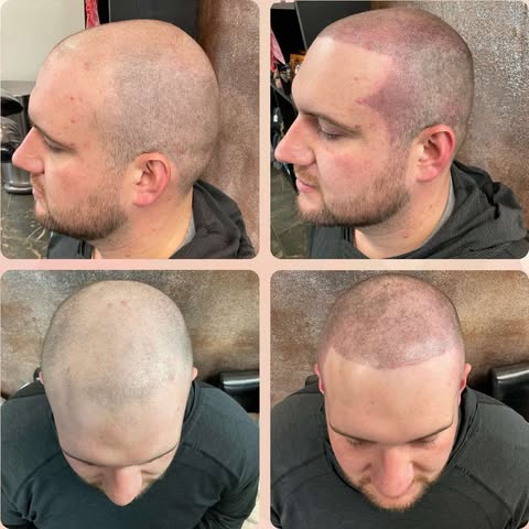 Scalp Micropigmentation at Peridot Studio in Lubbock, TX