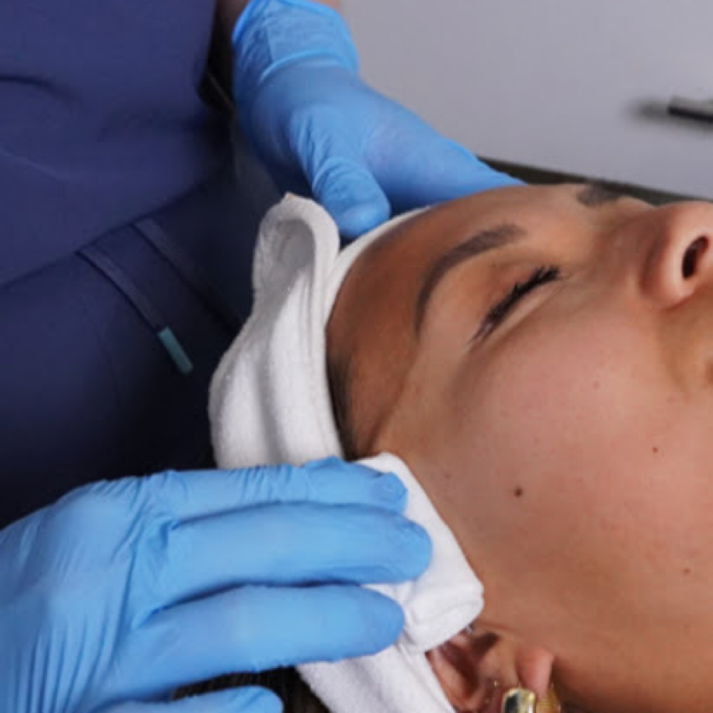 Acne Peel Treatment at Holistic Skin Center in Edgewater, FL