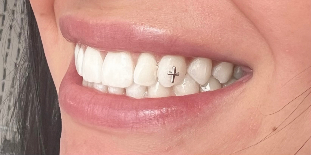 Tooth Gems