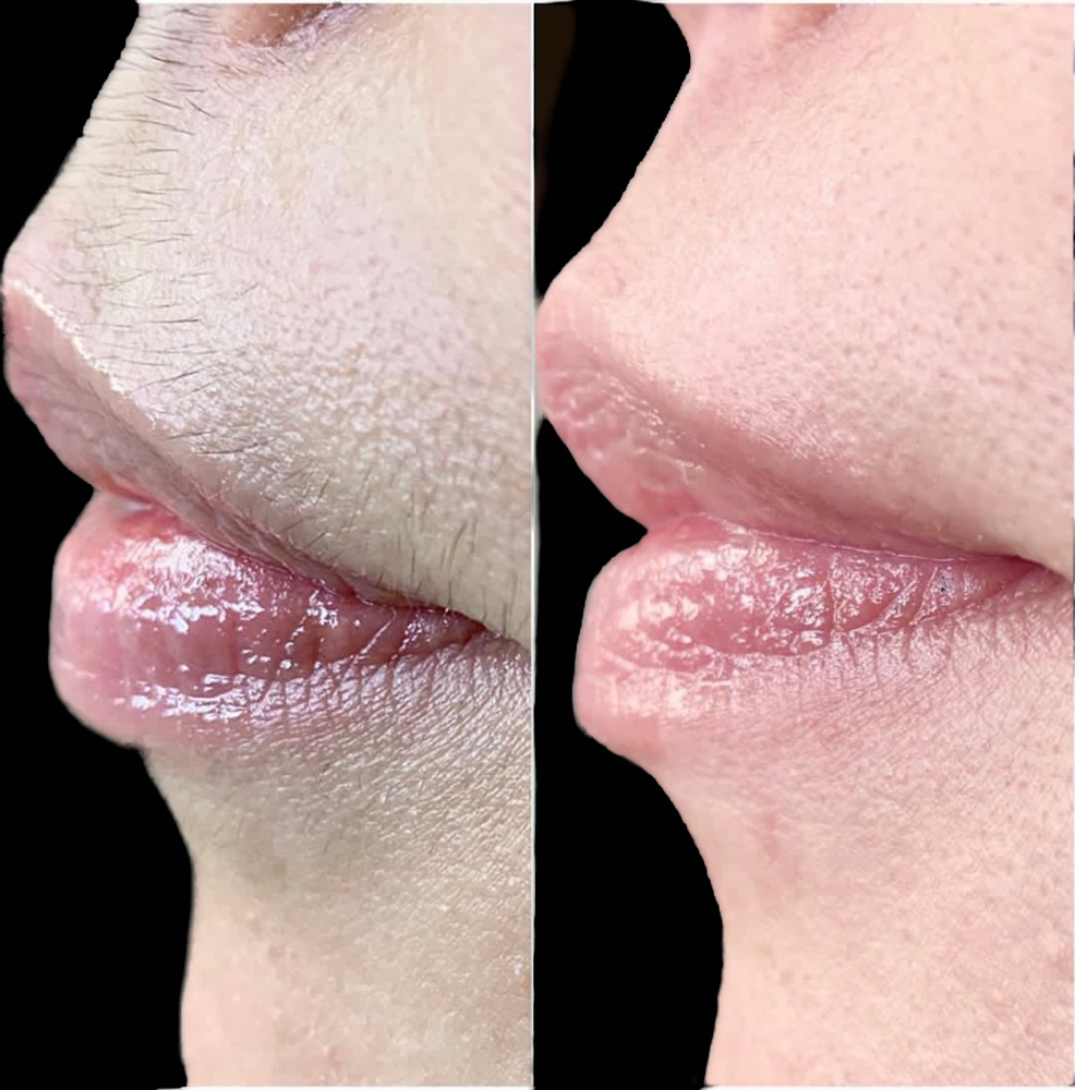 Upper & Lower Lip (add on)