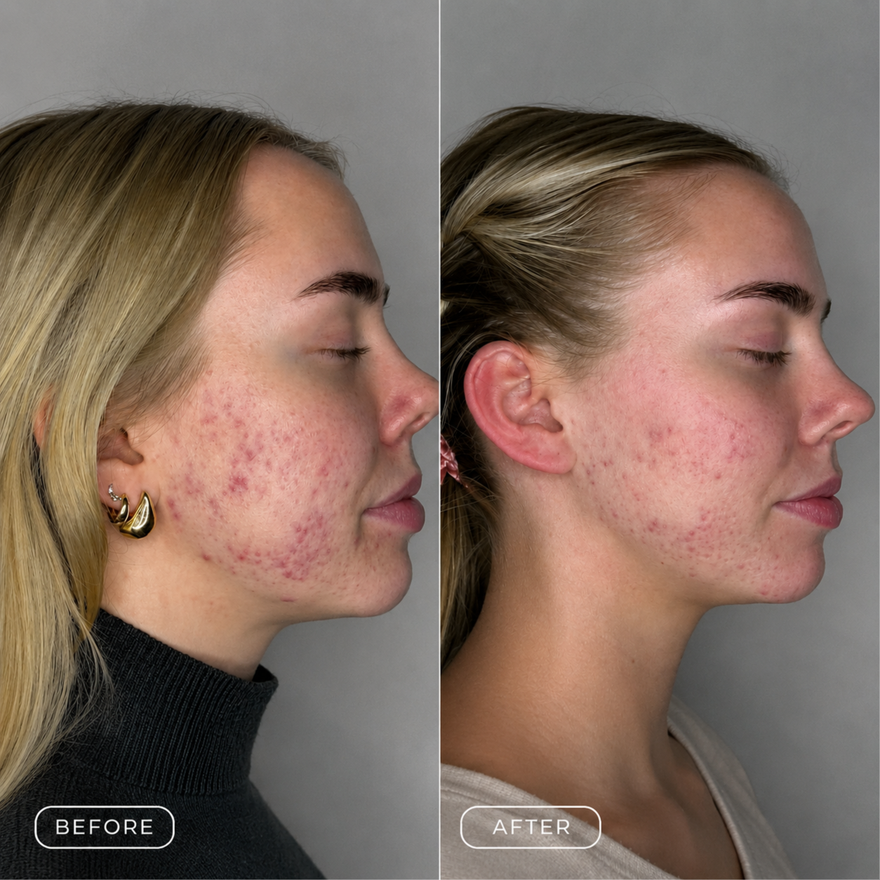 10 Weeks Acne Transformation at Breeze Spa in Myrtle Beach, SC