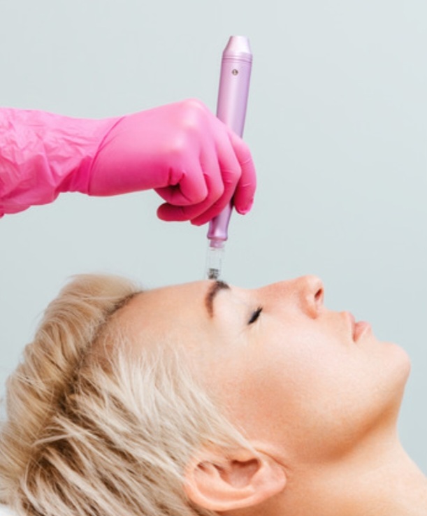 Microneedling (FACE)