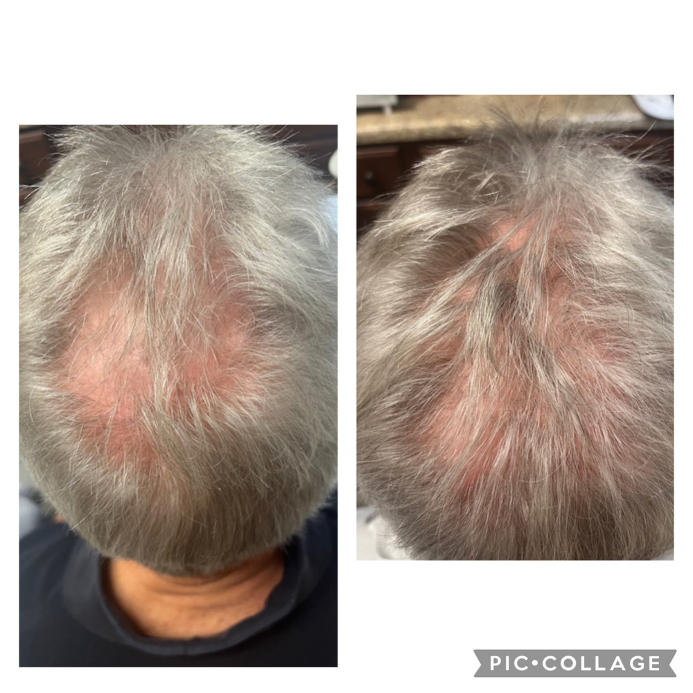 IL Plasma Hair Resteration at Efflorescence spa in Oakmont, PA