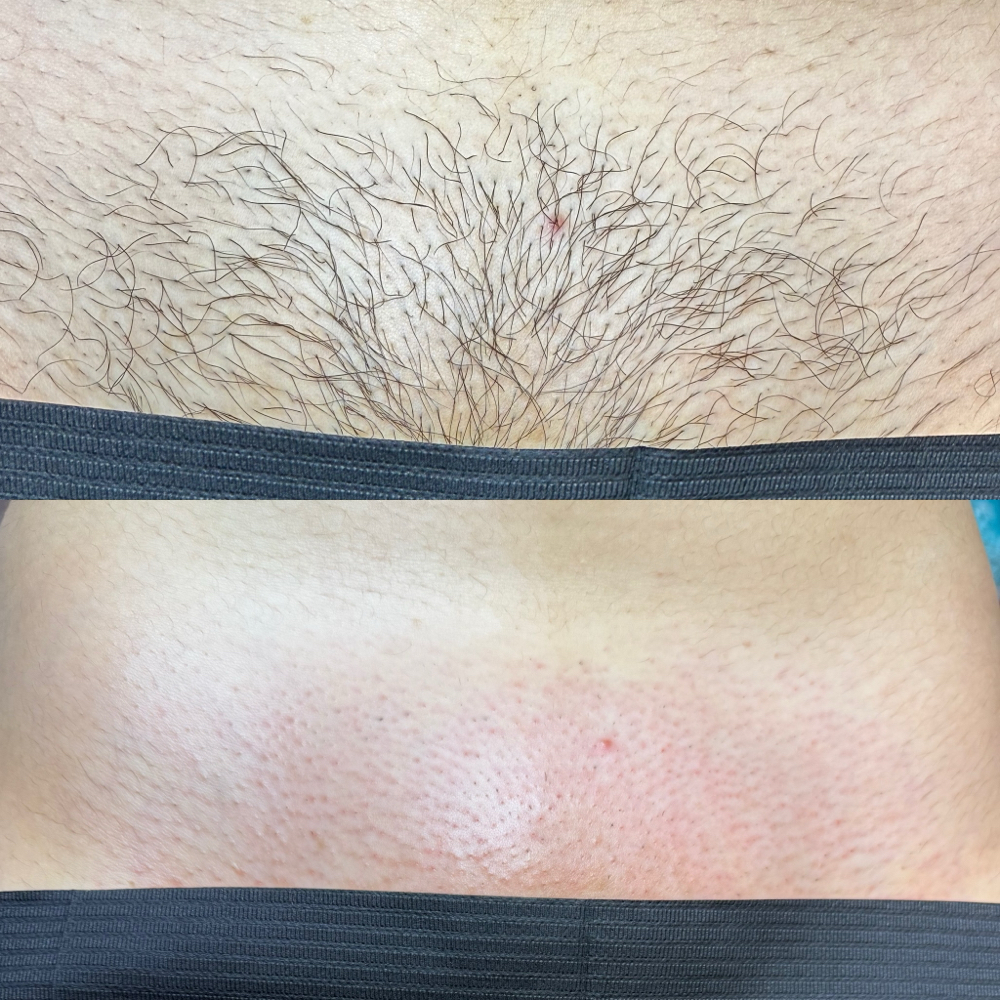 Brazilian Sugaring at Vixen Brows & Sugar Waxing in Corona, CA