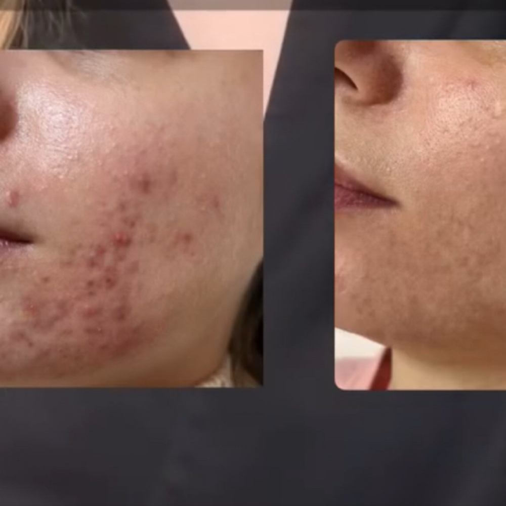 Pirify Peel at Heavenly Esthetics Skincare in Latham, NY