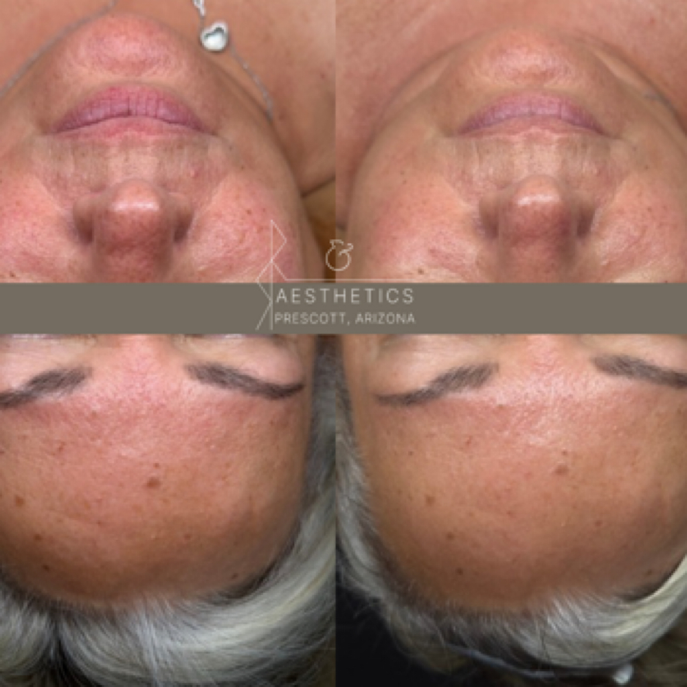 Barrier Balance Peel at R&R Aesthetics - Prescott, Arizona in Prescott, AZ