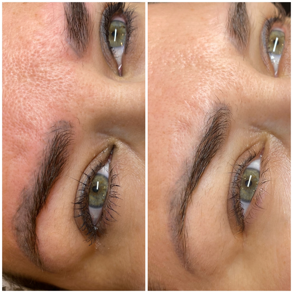 Removal (Permanent Makeup-Eyebrows)