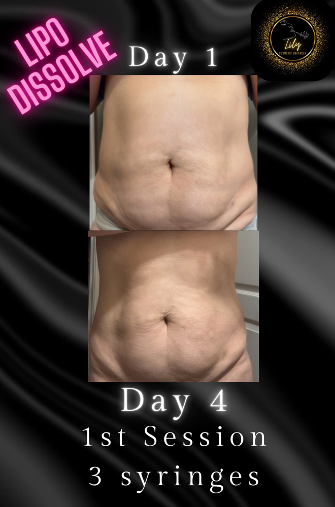 Lipo Dissolve Large Areas