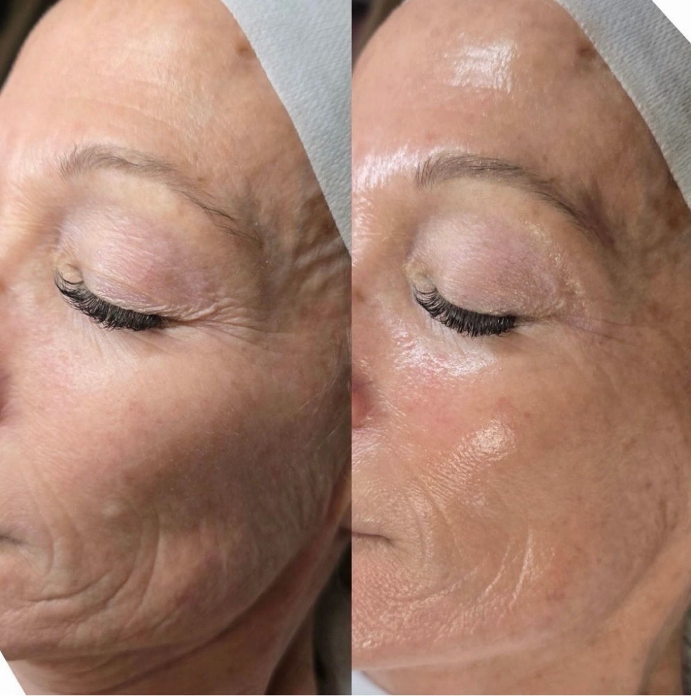Lift And Glow Edit Facial at The Full Edit Aesthetic Studio in Florence, AL