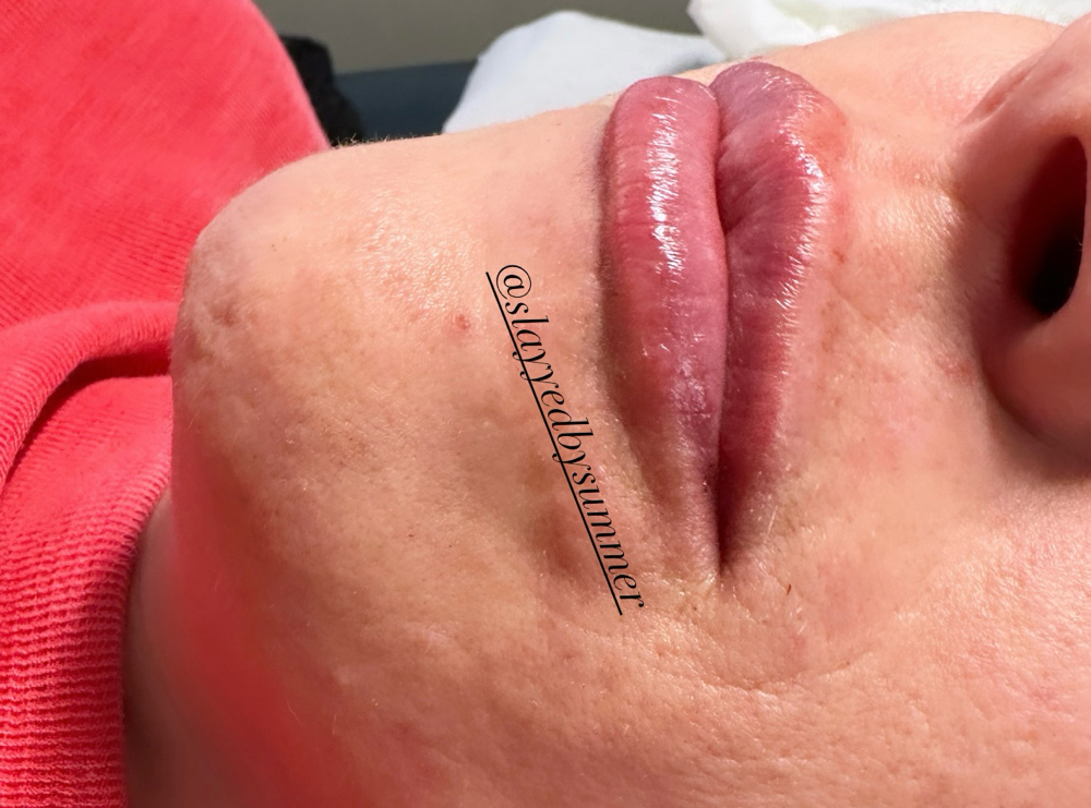 ✨2 Syringes Of Filler!✨