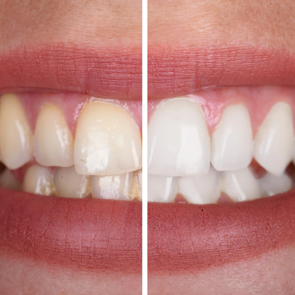 Teeth Whitening at Rewind Med Spa in Longmont, CO