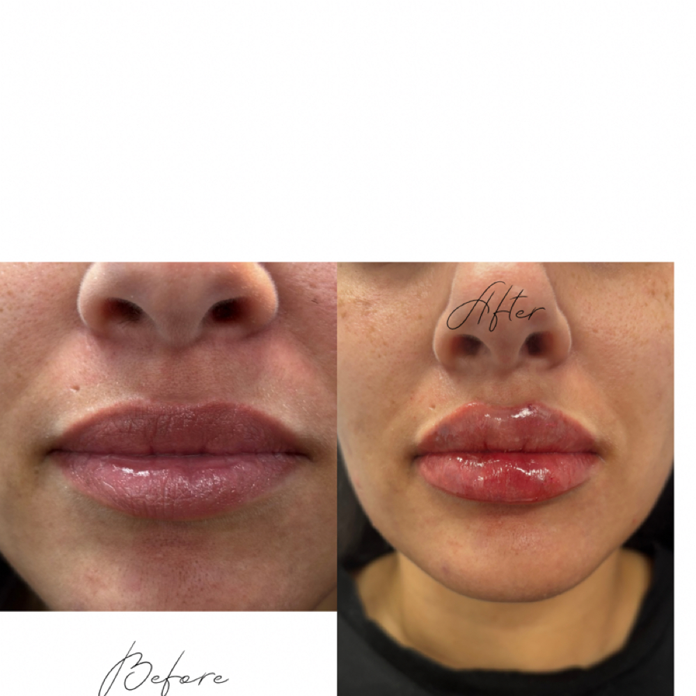 Lip Filler Full Syringe W/ Lip Flip at Davis Wellness & Aesthetics in Cleburne, TX