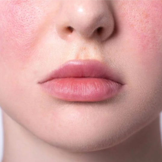 Sensitive Skin Facial at Frilly Face Skincare Studio in Santa Cruz, CA