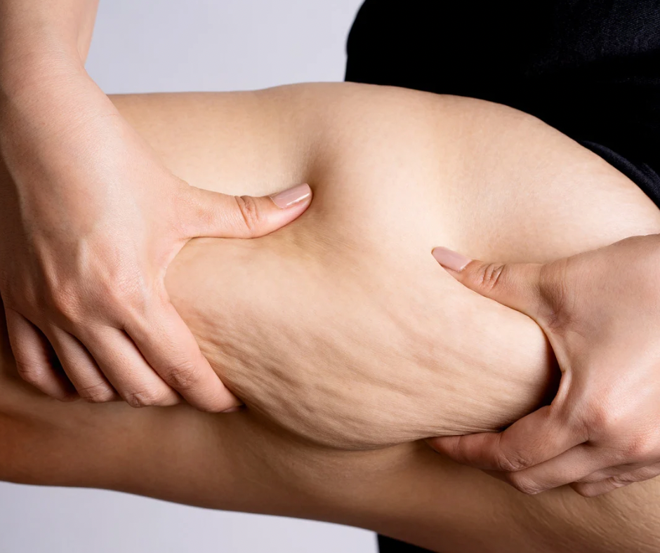 Cellulite Treatment