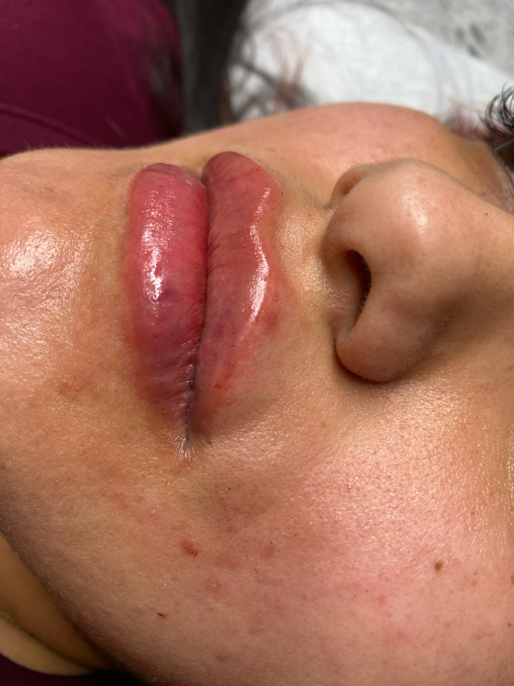 HA 1ml Lip Filler