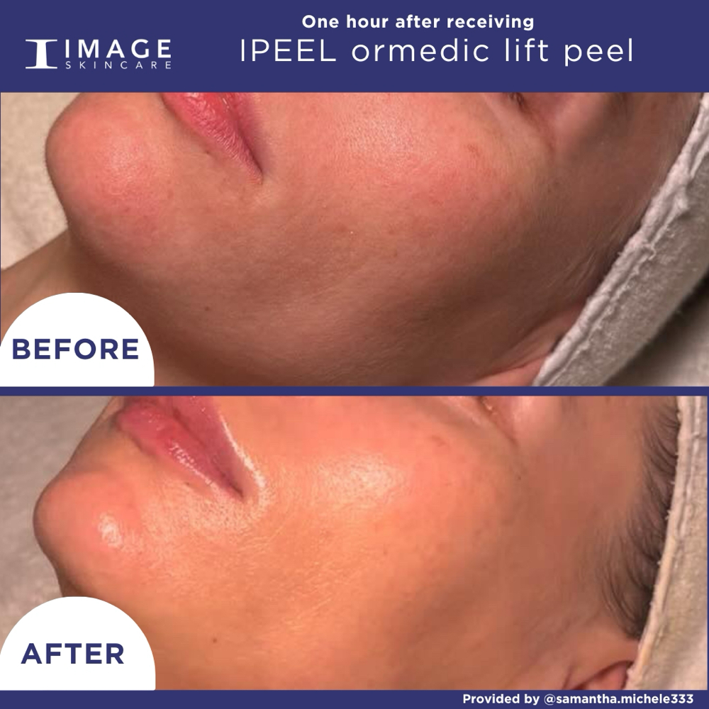 Ormedic Lift
