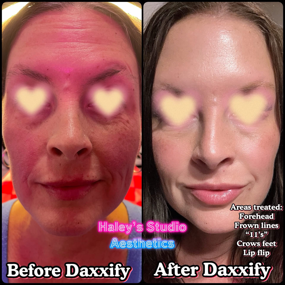 Tox- Daxxify