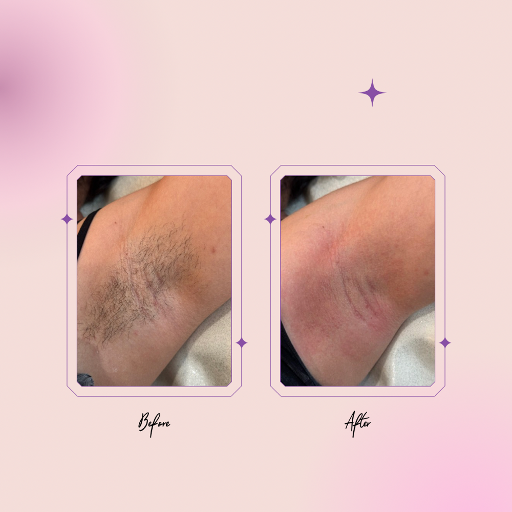 Underarm Maintence