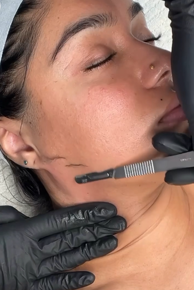 DERMAPLANE FACIAL