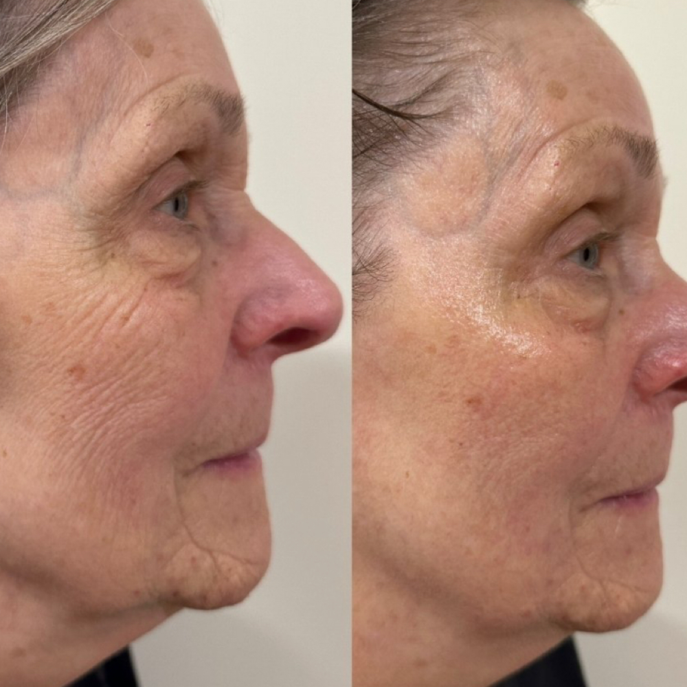 Korean Glass Skin Lifting Facial at Soul to Skin Esthetics in Bend, OR