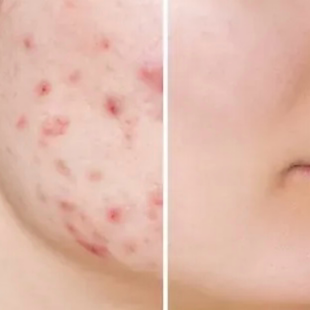 Anti-Acne Chemical Peel at Glass Skin Studio in West Bloomfield, MI