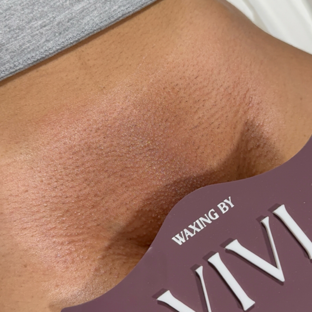 Full Brazilian wax at The Epilation Lab in New Britain, CT