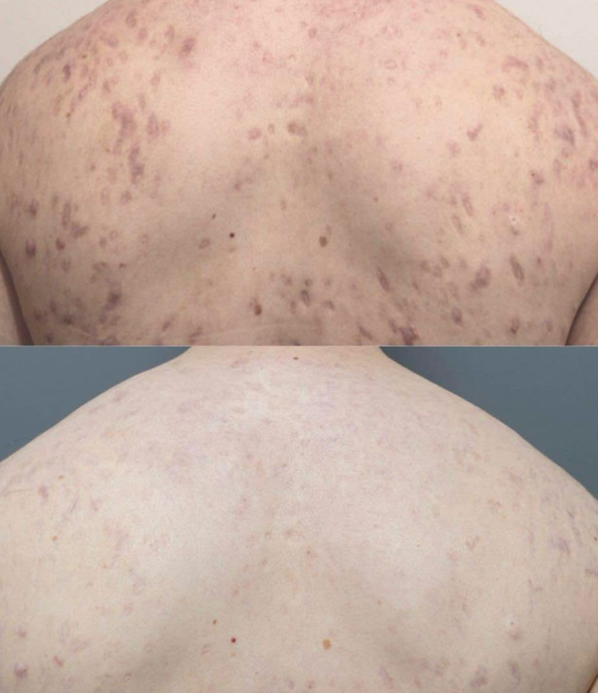 Exosome Microneedling Back