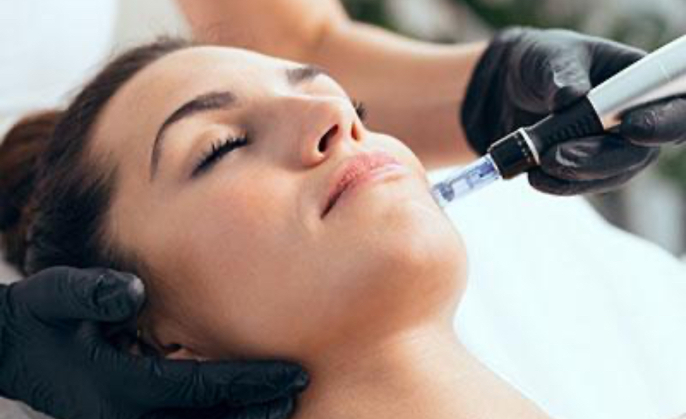 Advanced Microneedling with PDRN