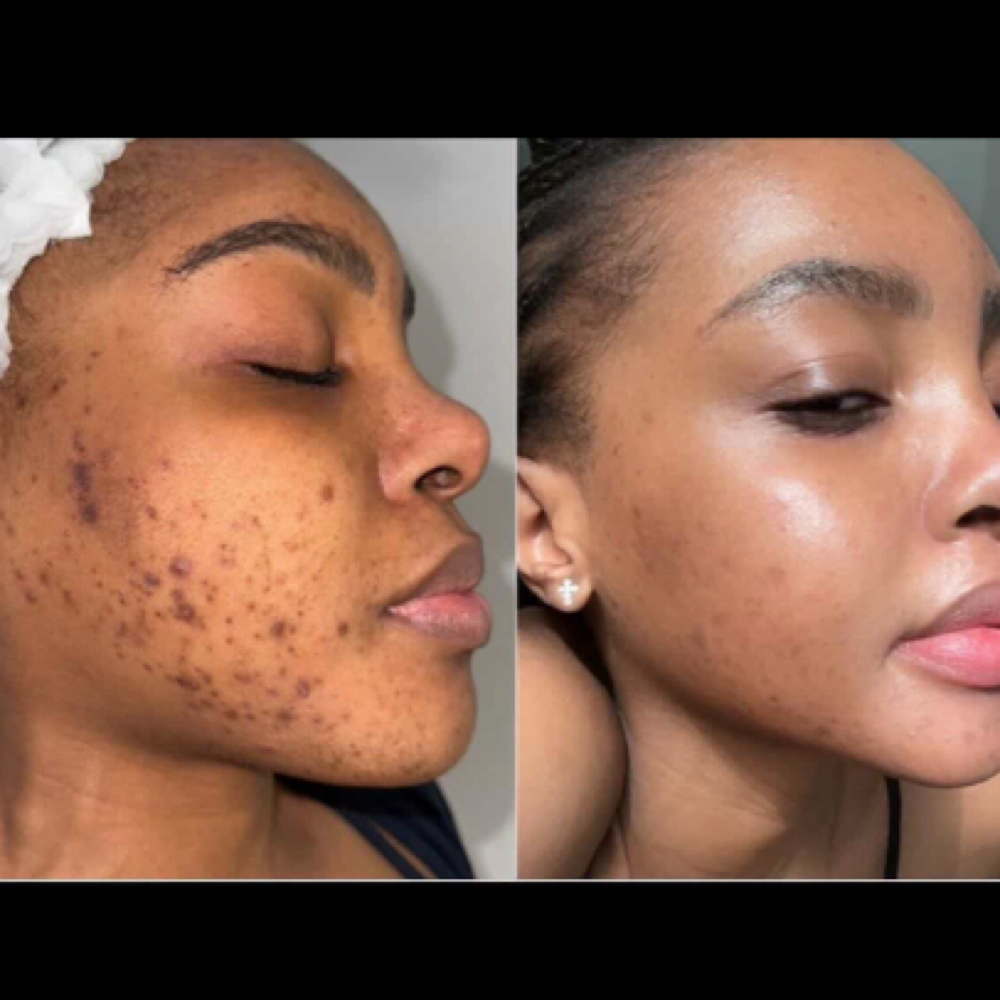 Organo Herbal Peel at Sonder Skin in Newport News, VA