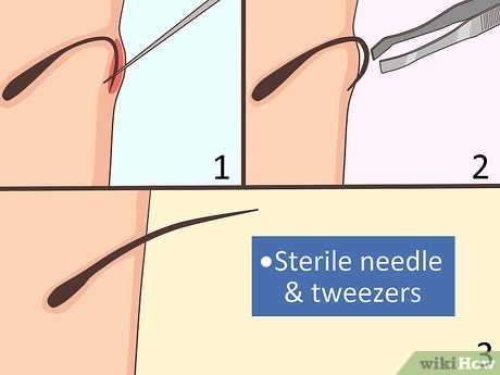 Ingrown Hair Removal