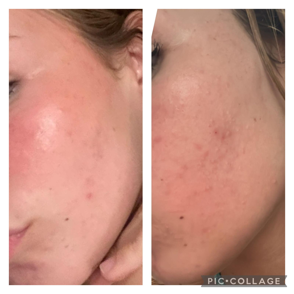 Facial Acne (teen)