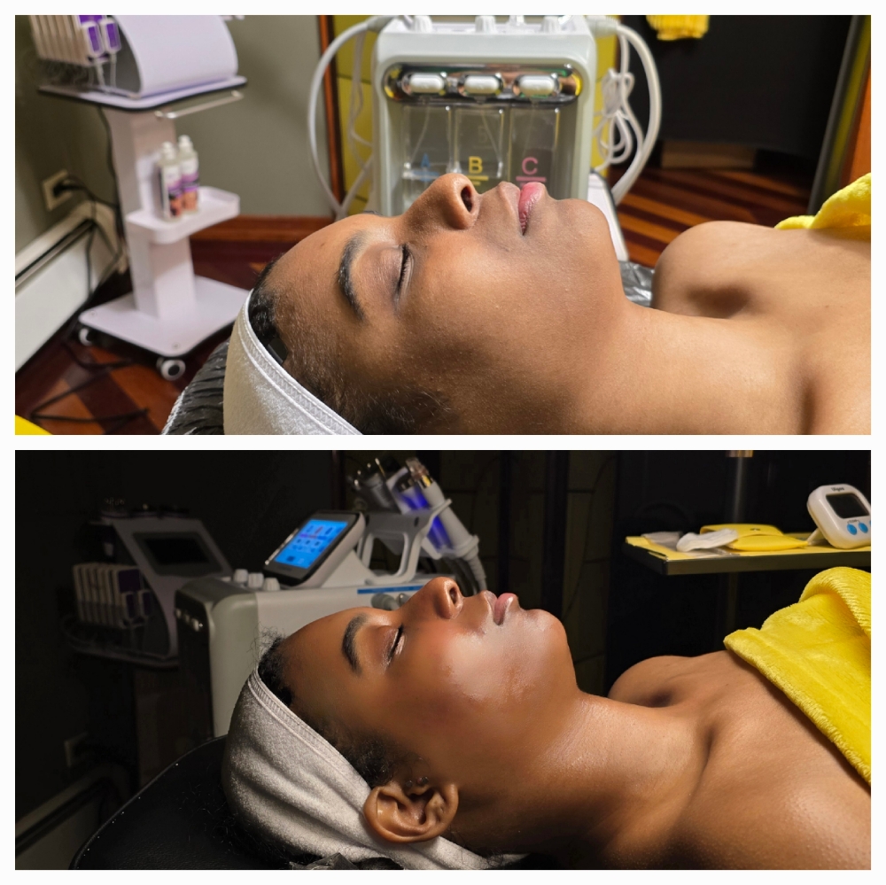 Diamond Microdermabrasion Facial