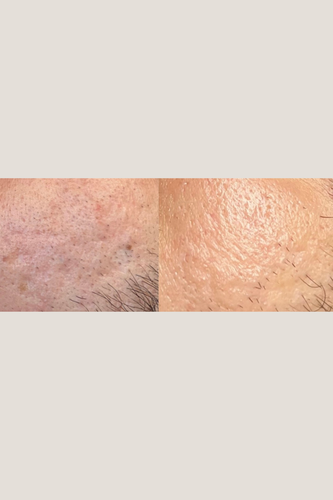 Resurfacing Microneedling (4TX)
