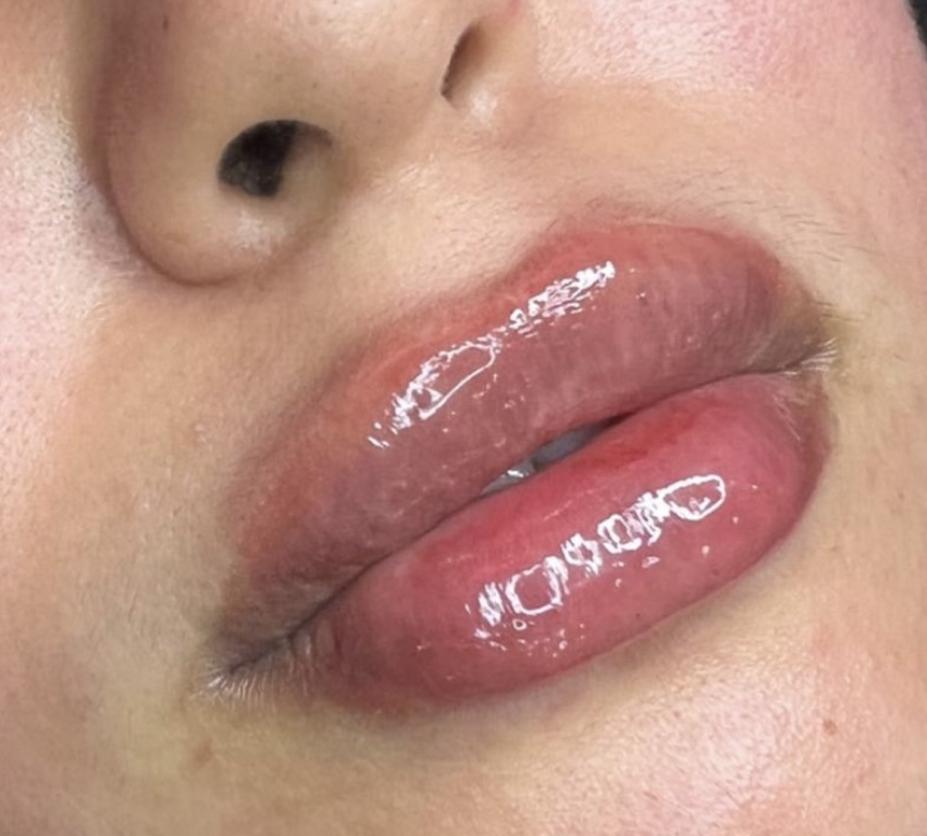 Lip Plumping Treatment