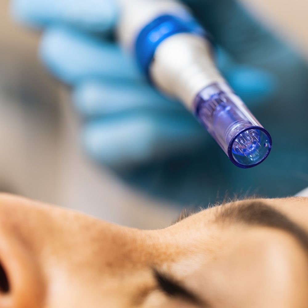 MICRONEEDLING