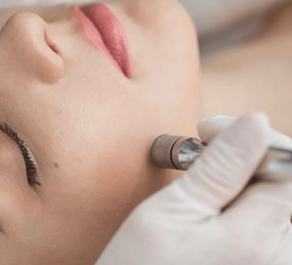 Microdermabrasion Facial