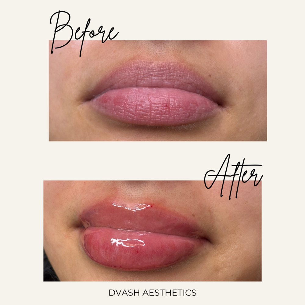 Bestie HALF syringe Lip filler at Dvash Aesthetics in Lubbock, TX