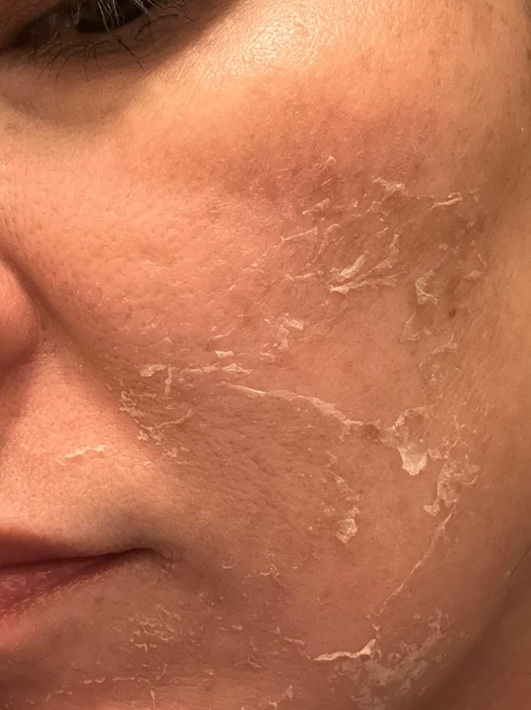 GreenSeaPeel (Liquid Microneedling)