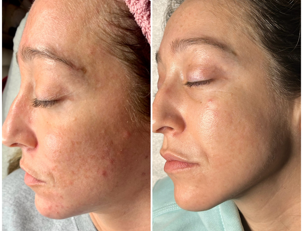 Acne boot camp virtual consultation