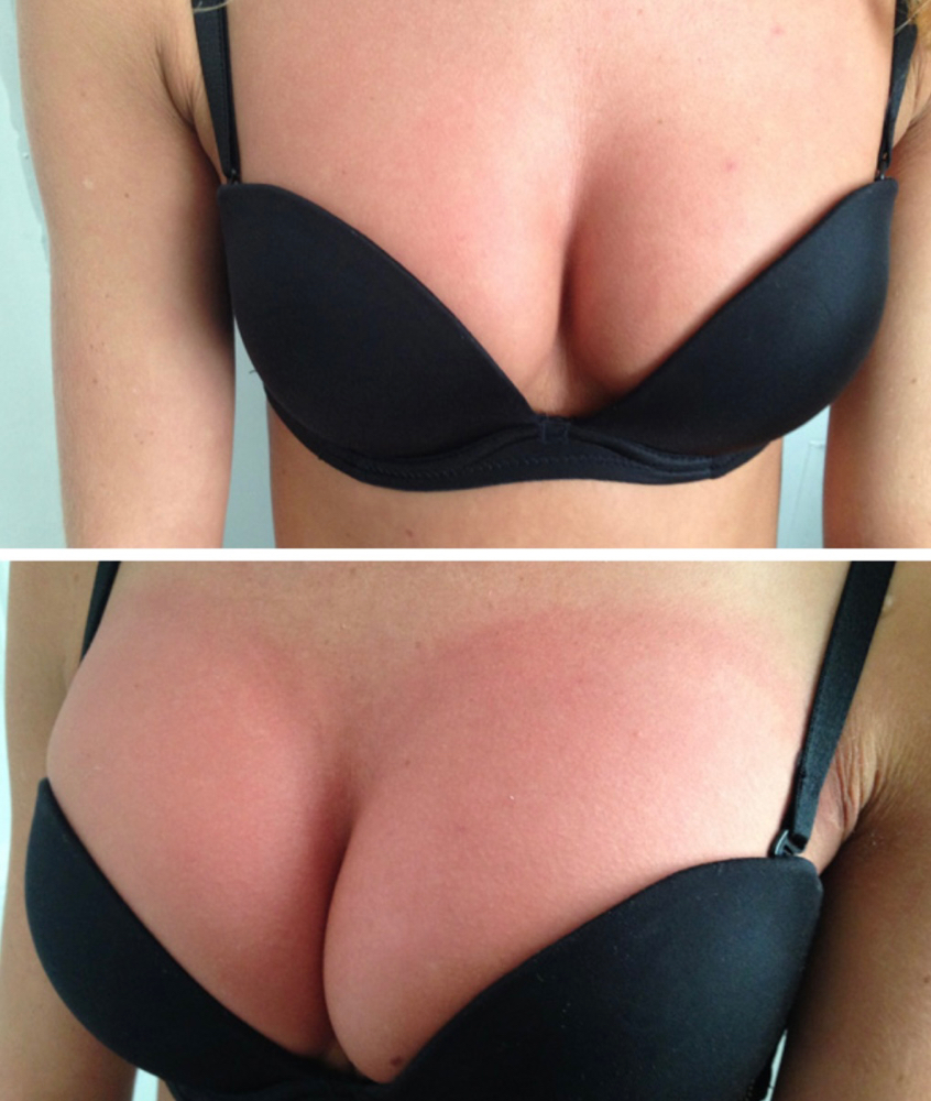 Breast Enhancement 3Seasion Package