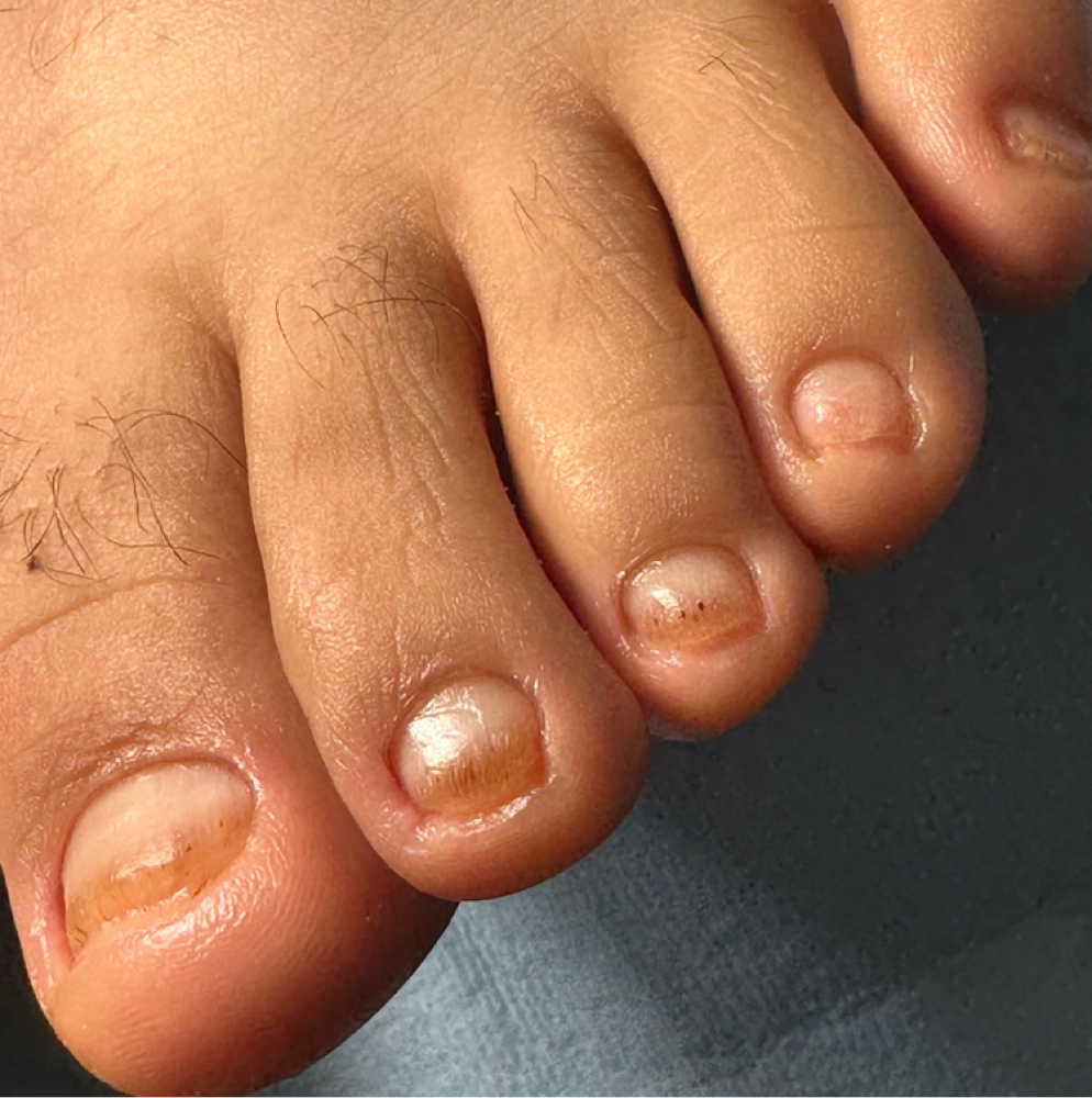 QUIROPEDIA | CHIROPODY Control at Confident Foot Care by Aracely Xicara in Huntington Park, CA