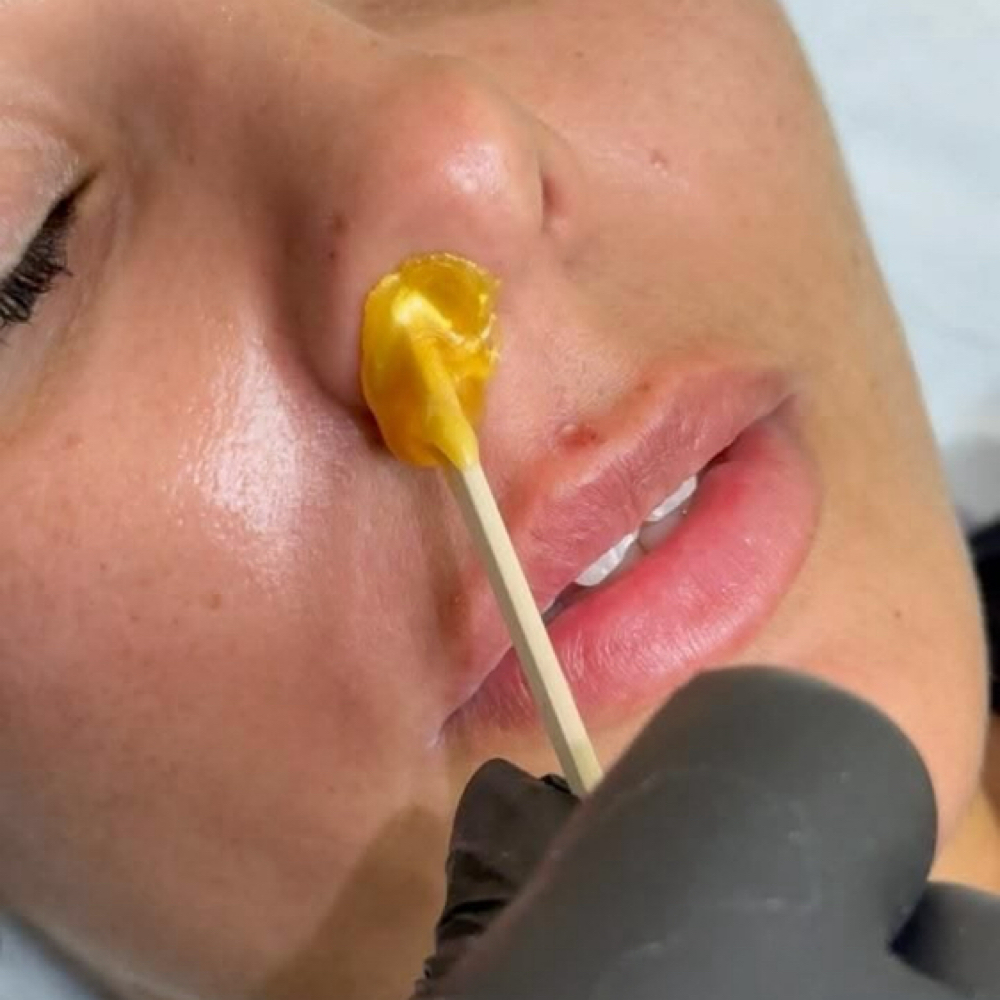 Nose at Andrew Gaines Aesthetics in Warner Robins, GA