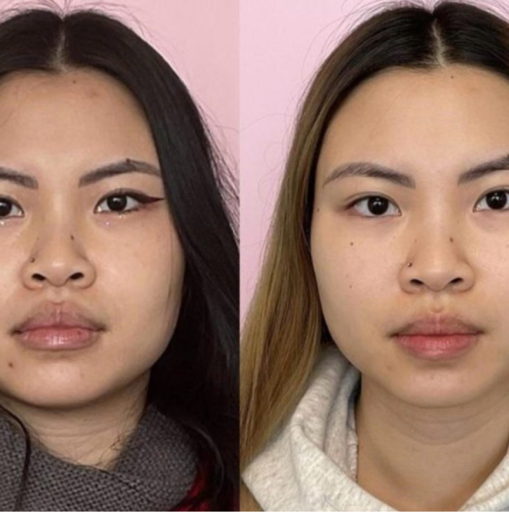 Masseter Botox (Jaw Slimming / TMJ) at Flawless Spa & Beauty in Fort Worth, TX