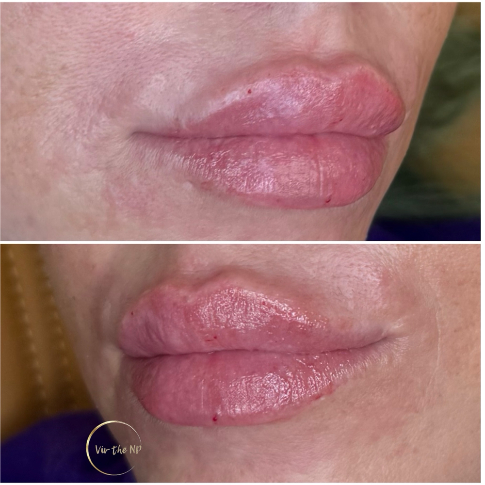 Summer Special: $475 Lips