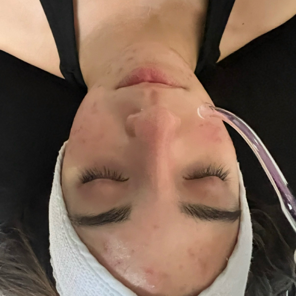 💫 Teen Clear Start Facial at Complete Complexion Skin Lounge in Irving, TX