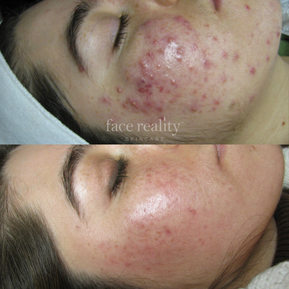 Acne Consultation + 1st Treatment at Bella Glow Skin and Body in San Antonio, TX