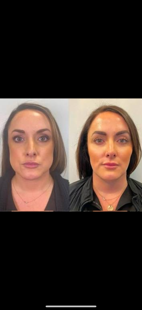 Masseter Muscle- Facial Slimming