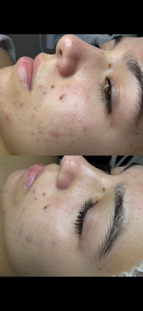 Teen Facial (ages 12-17) at Healthy skin by Alvina in Highland Park, IL